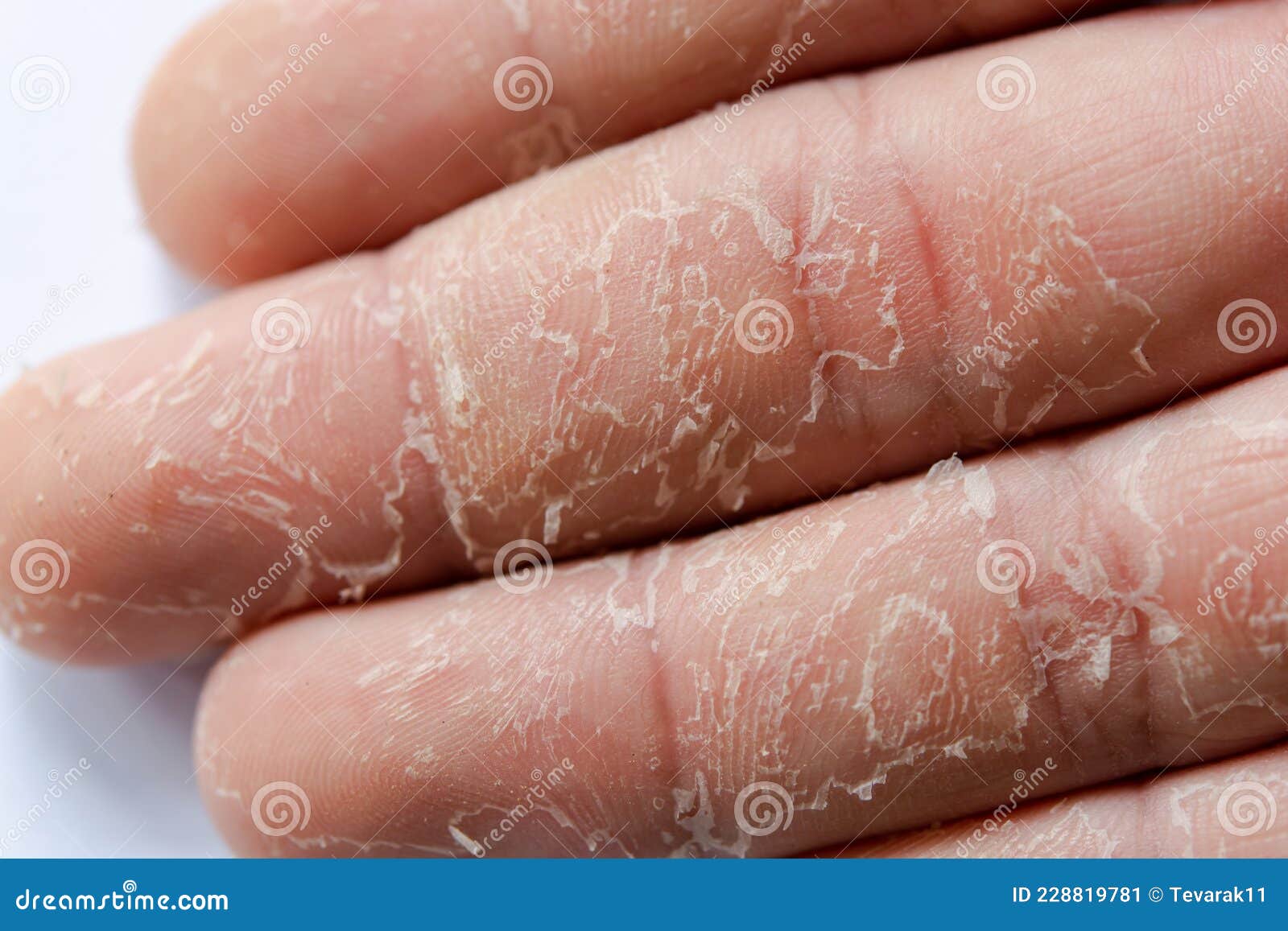 Peeling Skin On Hand And Fingers Desquamation Stock Image Image Of