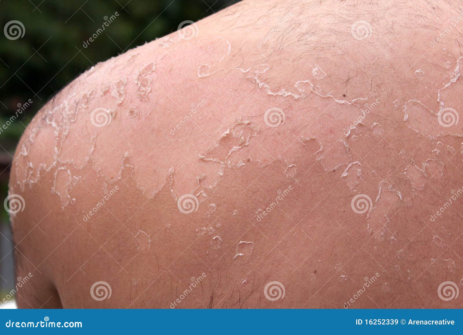 Peeling Sunburned Back Royalty Free Stock Images Image 16252339