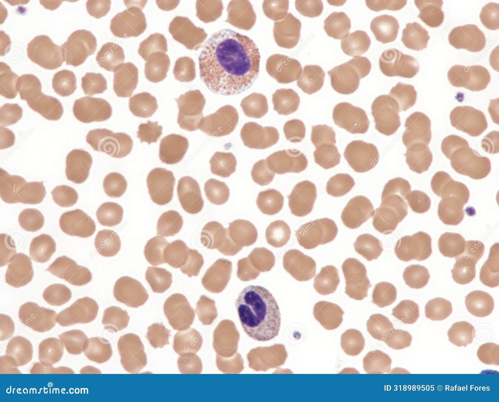 pelger huet anomaly acquired in a case of toxoplasmosis.