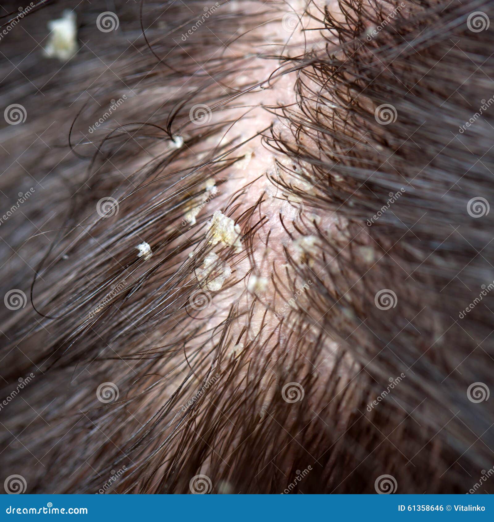 Pellicules Dans Les Cheveux Cuir Chevelu Floconneux Photo stock ...