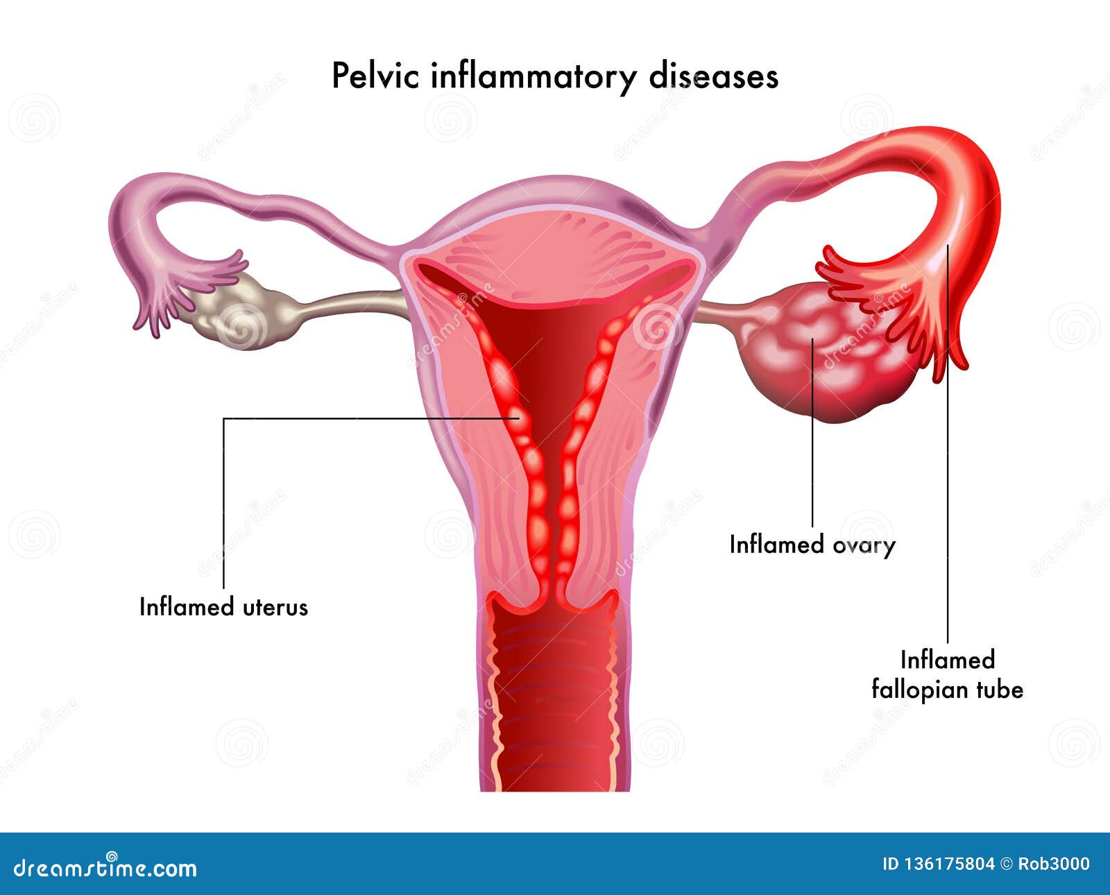 pelvic inflammatory disease 