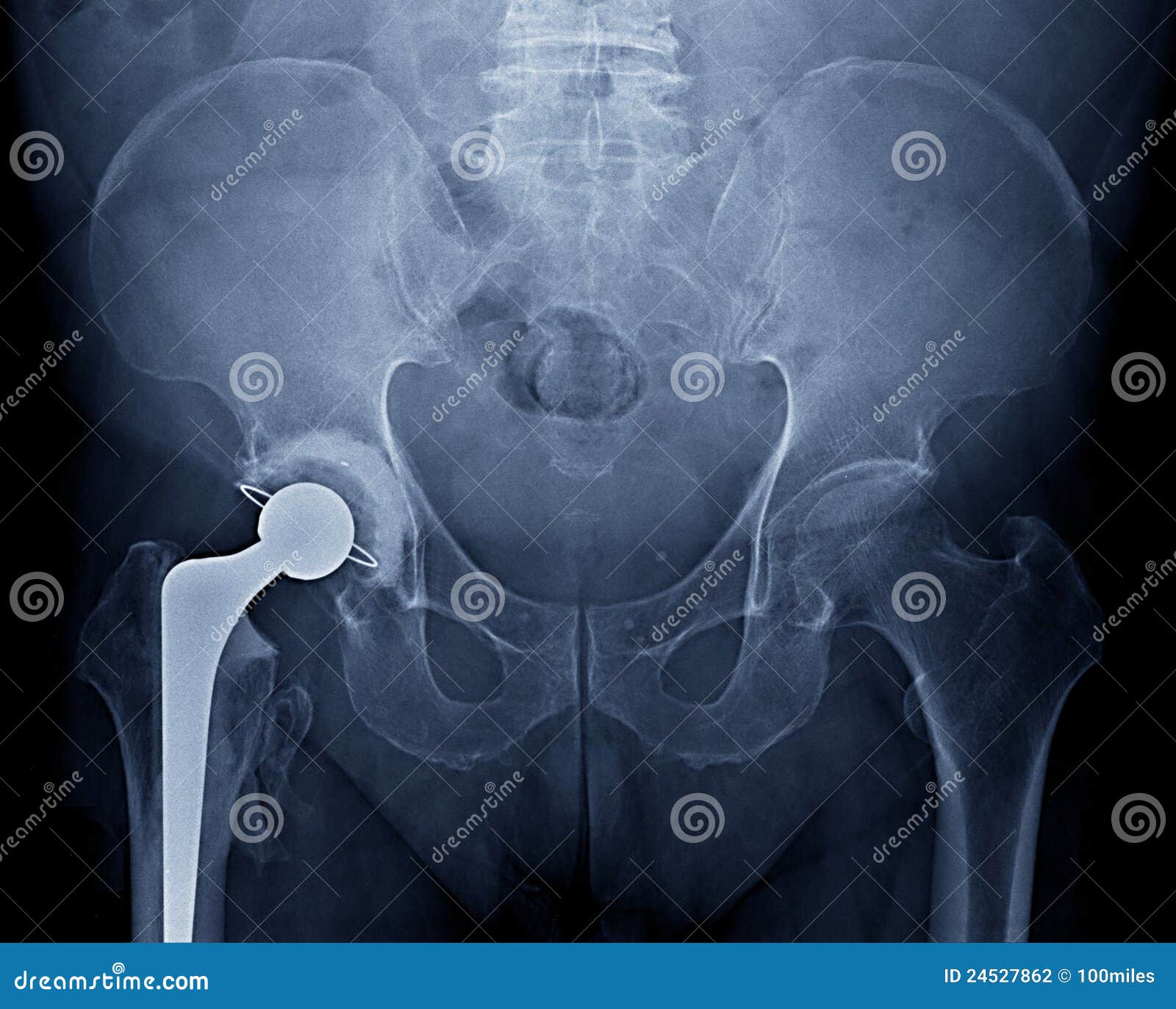 Pelvic Xray Stock Photography Image 24527862