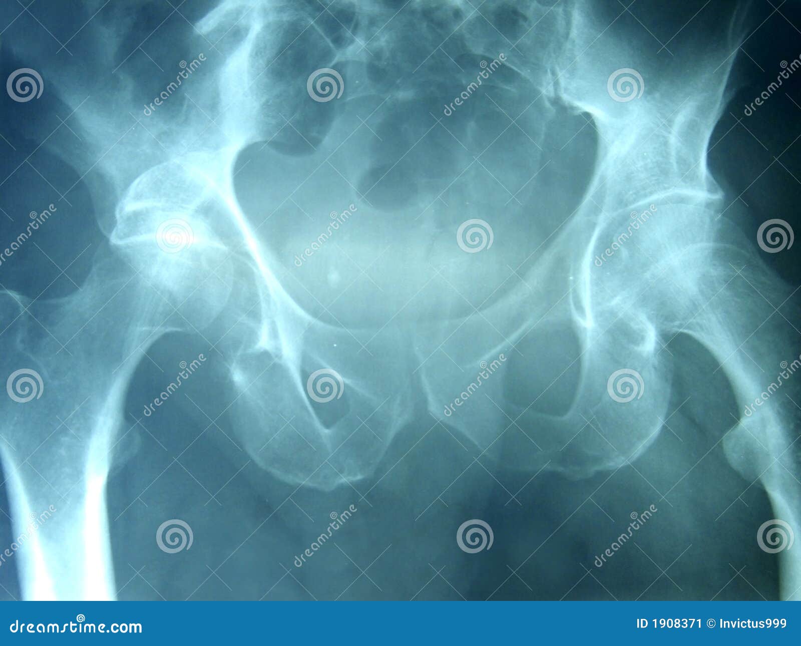 Pelvis Xray stock image. Image of medical, doctor, diagnose 1908371