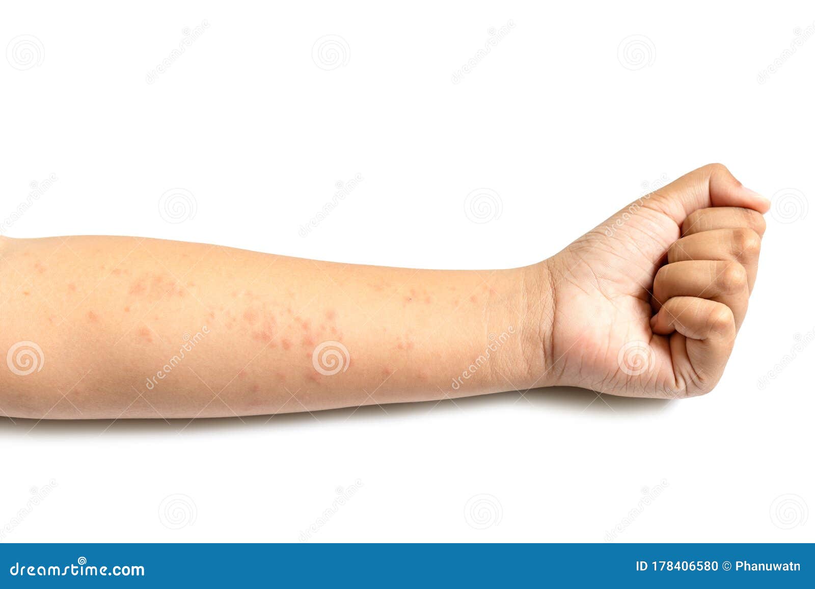 People Getting Red Rash on the Arm Skin Isolated White. Skin Care Concept Stock Photo - Image of hives, epidemiology: 178406580