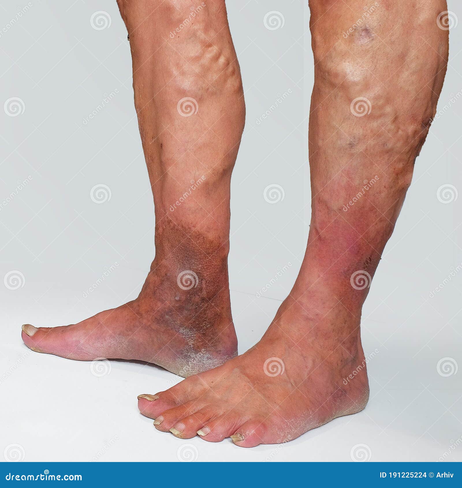 varicele pot mânca picioarele tratamentul venelor varicoase fara îndepartare