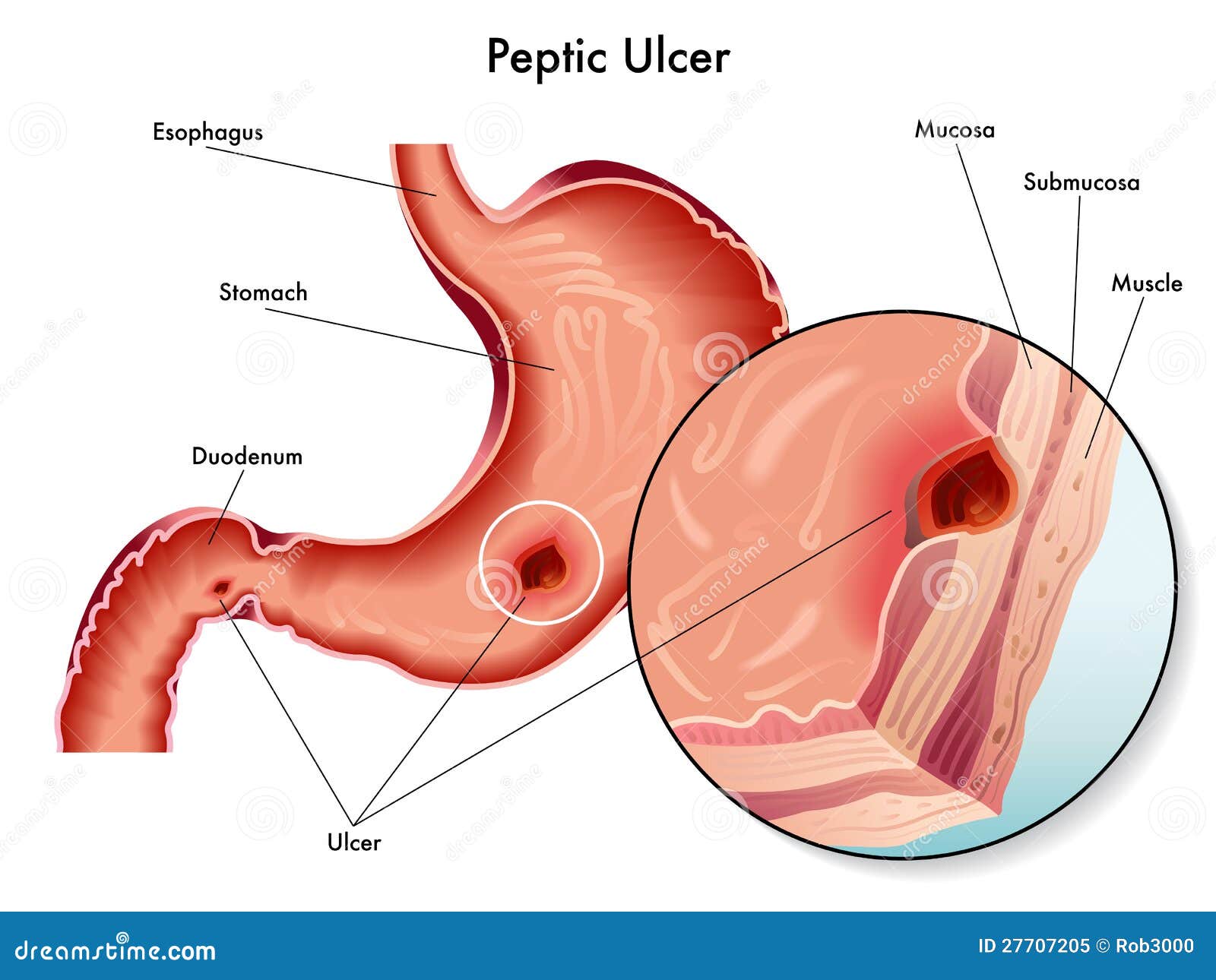 Peptic ulcer stock vector. Illustration of acid, pain ... helicobacter pylori esophagus diagram 