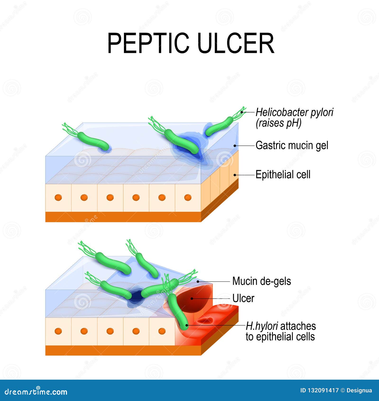 peptic ulcer and bacterial infection. helicobacter pylori