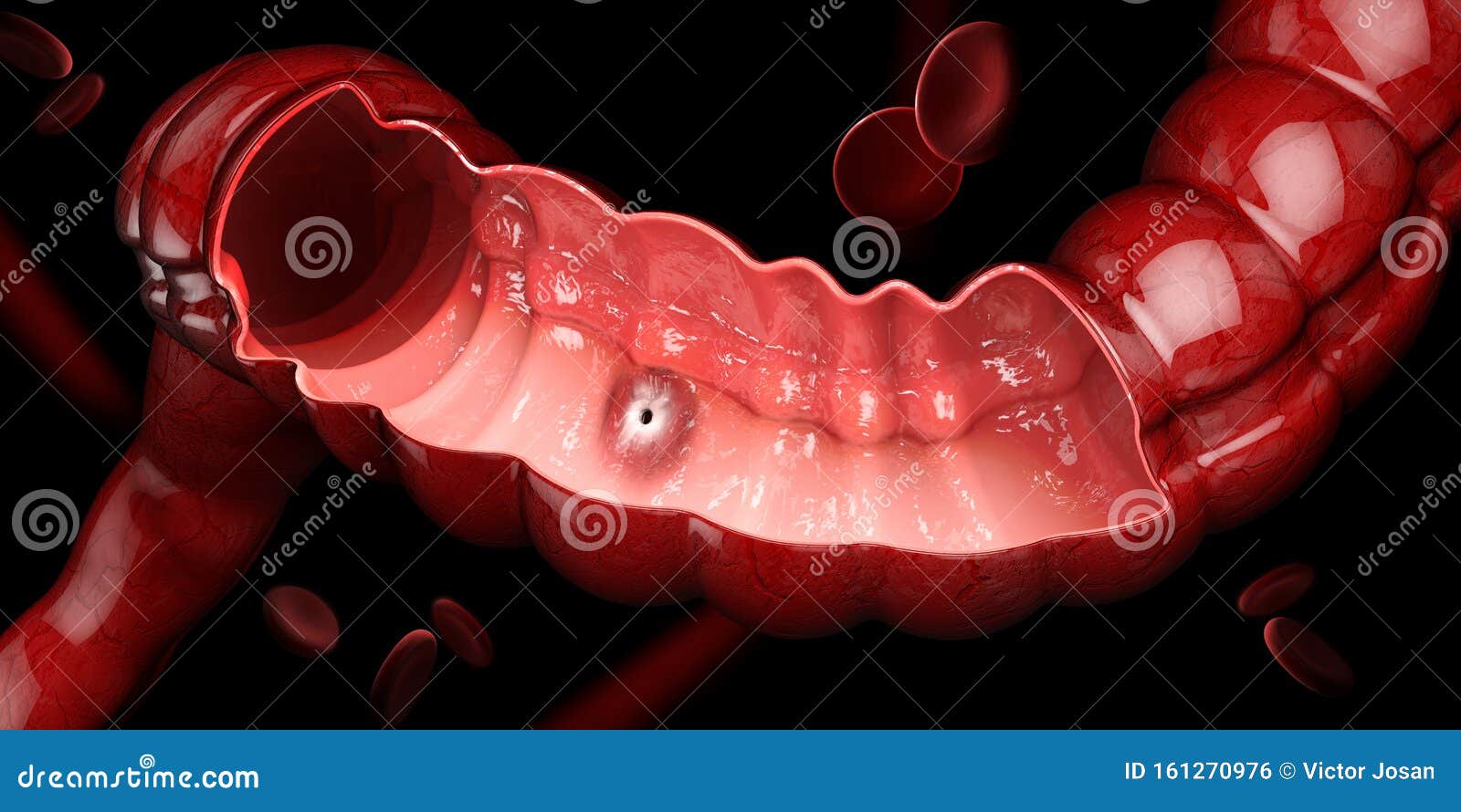 peptic ulcer, 3d  of human stomach anatomy.