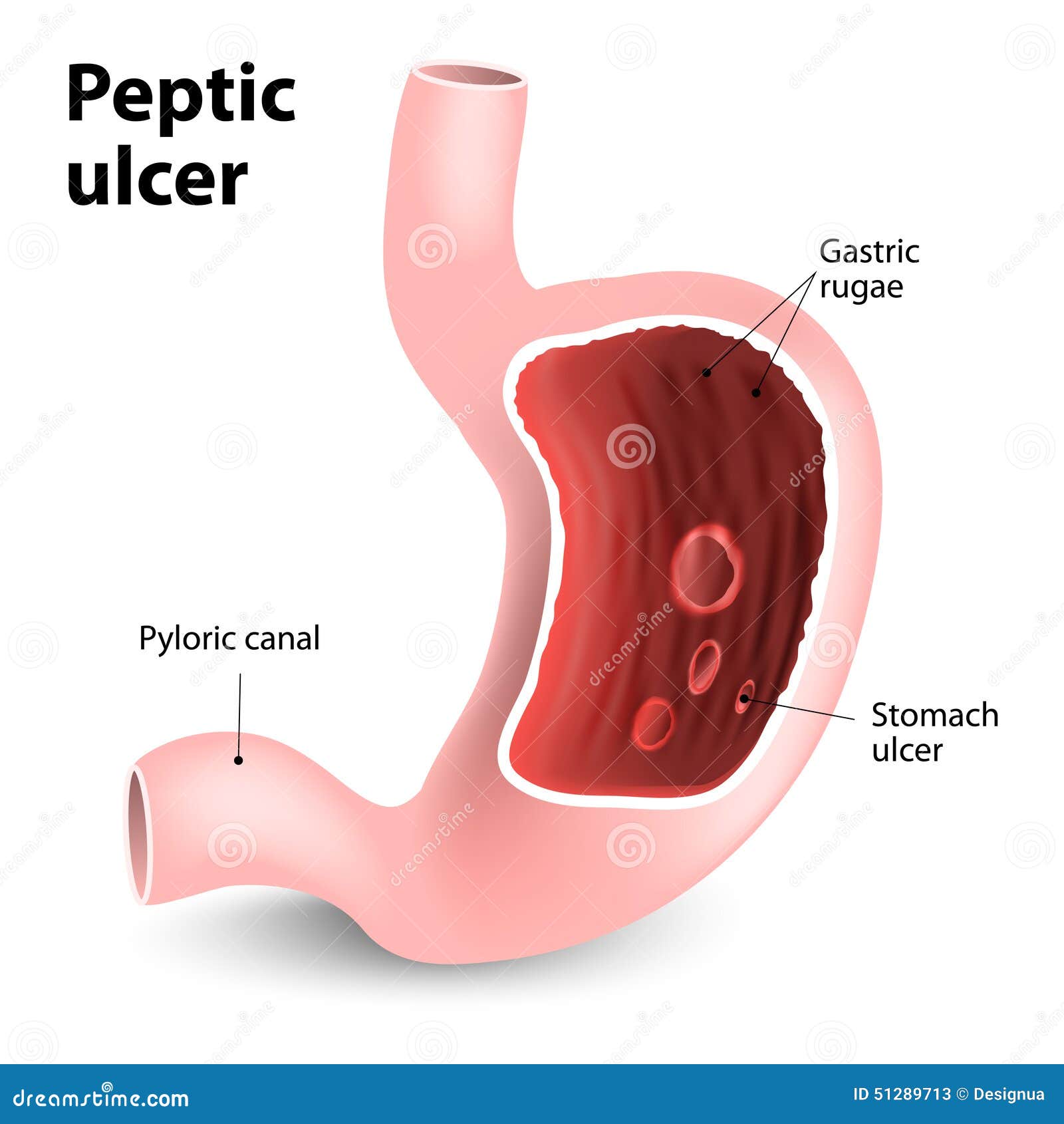 peptic ulcer