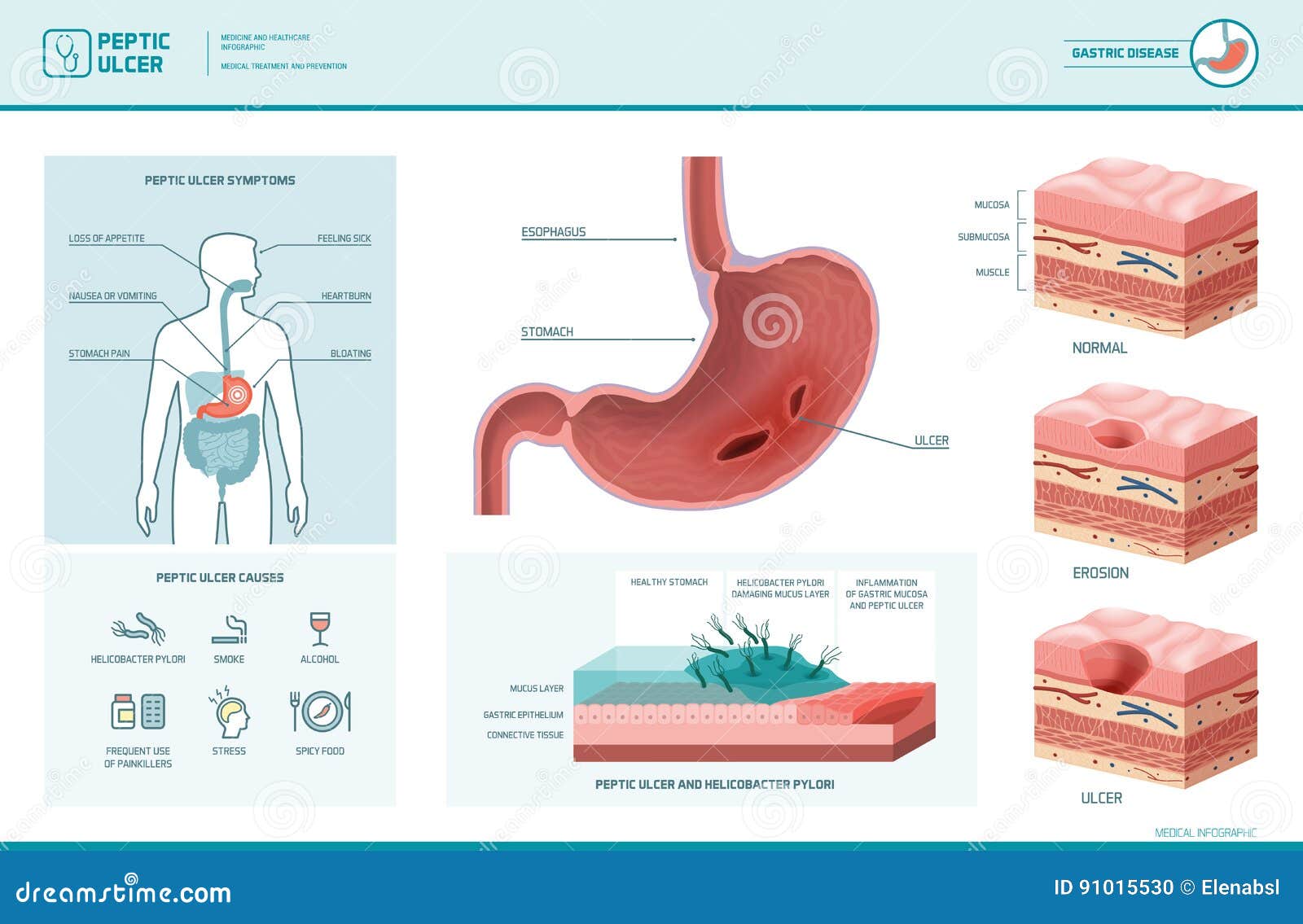 peptic ulcer and helicobacter pylori infographic