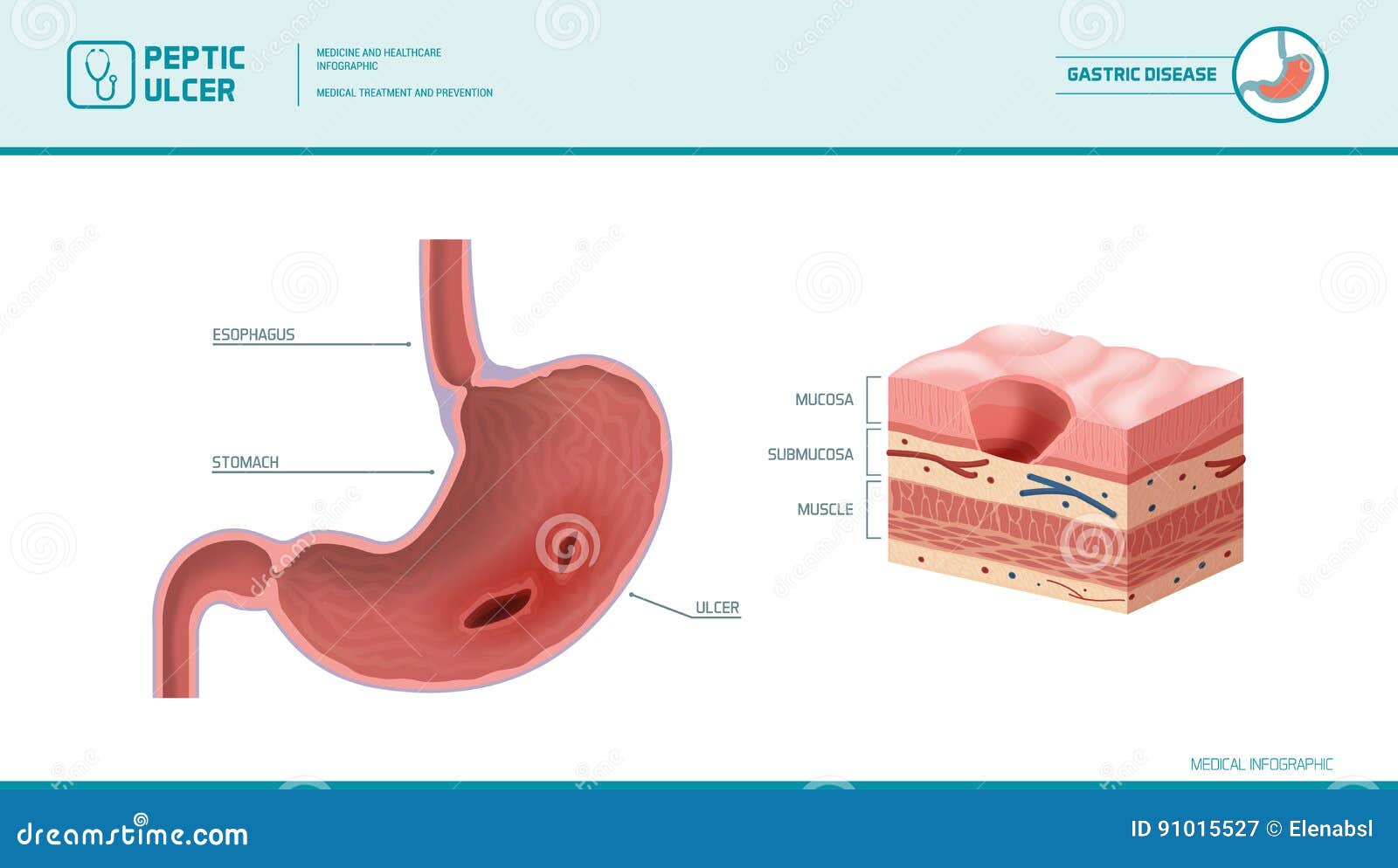 Peptic Ulcer Medical Illustration Stock Vector