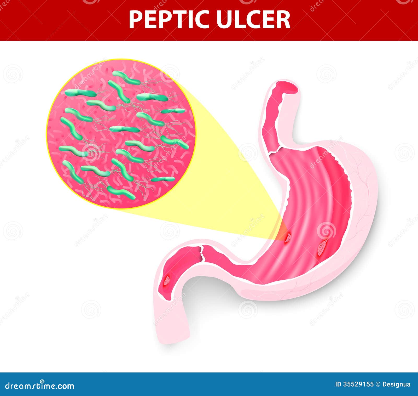 Peptic Ulcer Stock Vector  Illustration Of Medical