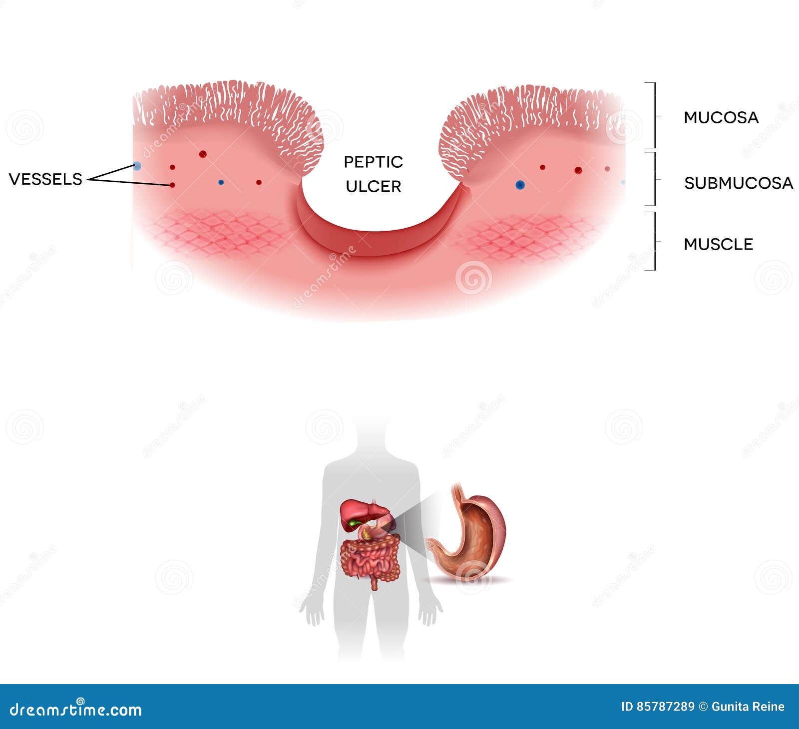 Peptic Ulcer Of The Stomach Stock Vector