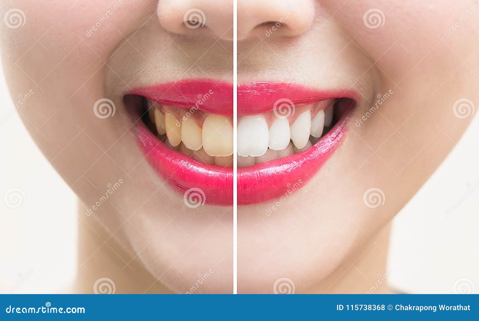 perfect smile teeth before and after bleaching. whitening teeth