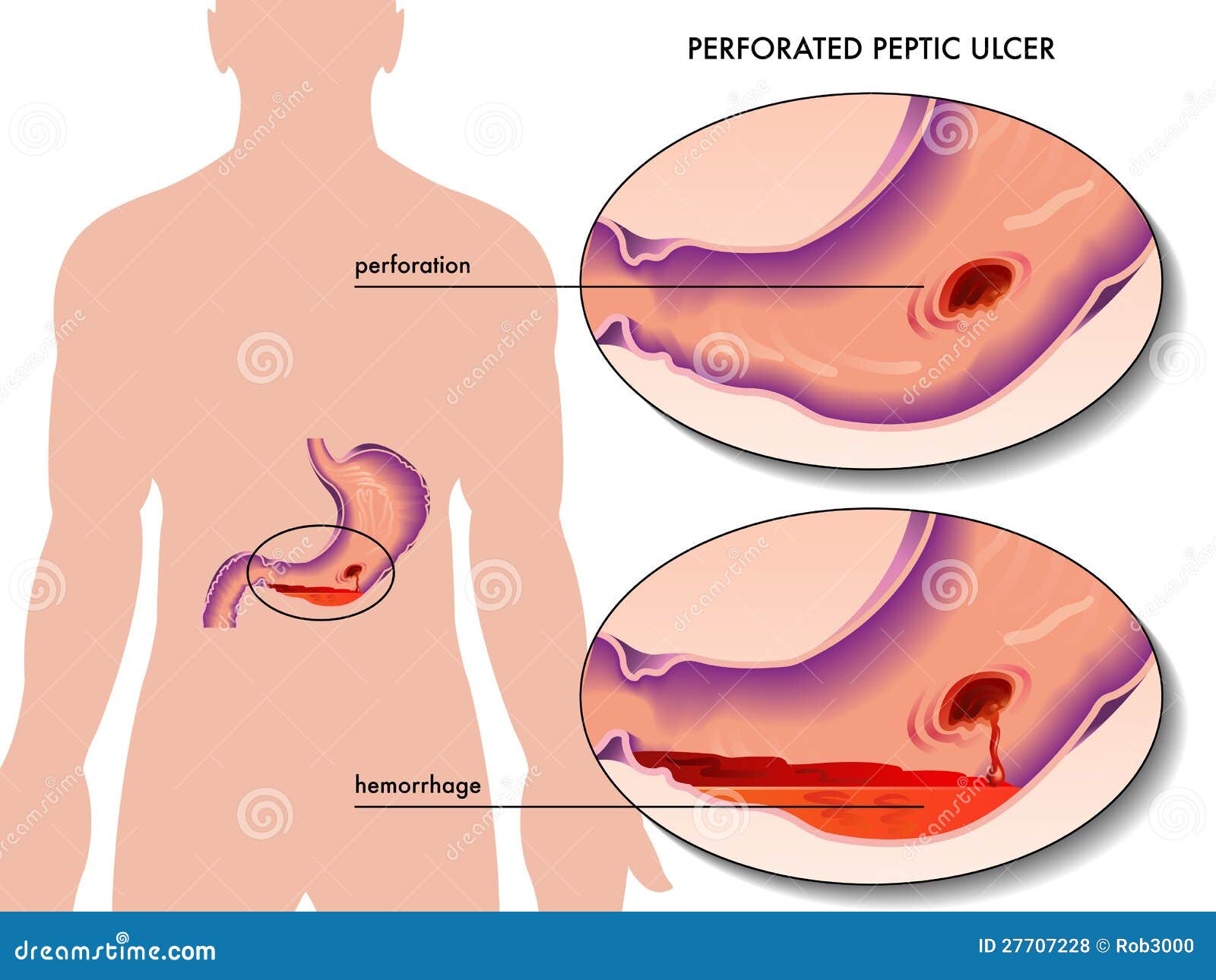 perforated peptic ulcer