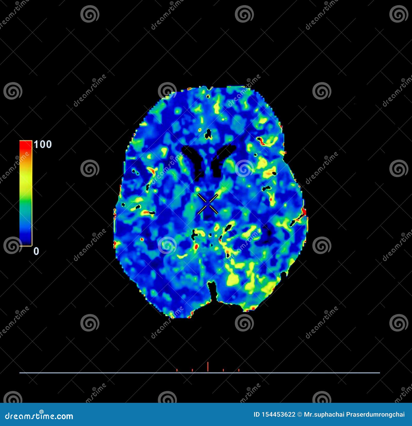 Brain Death Perfusion Scan