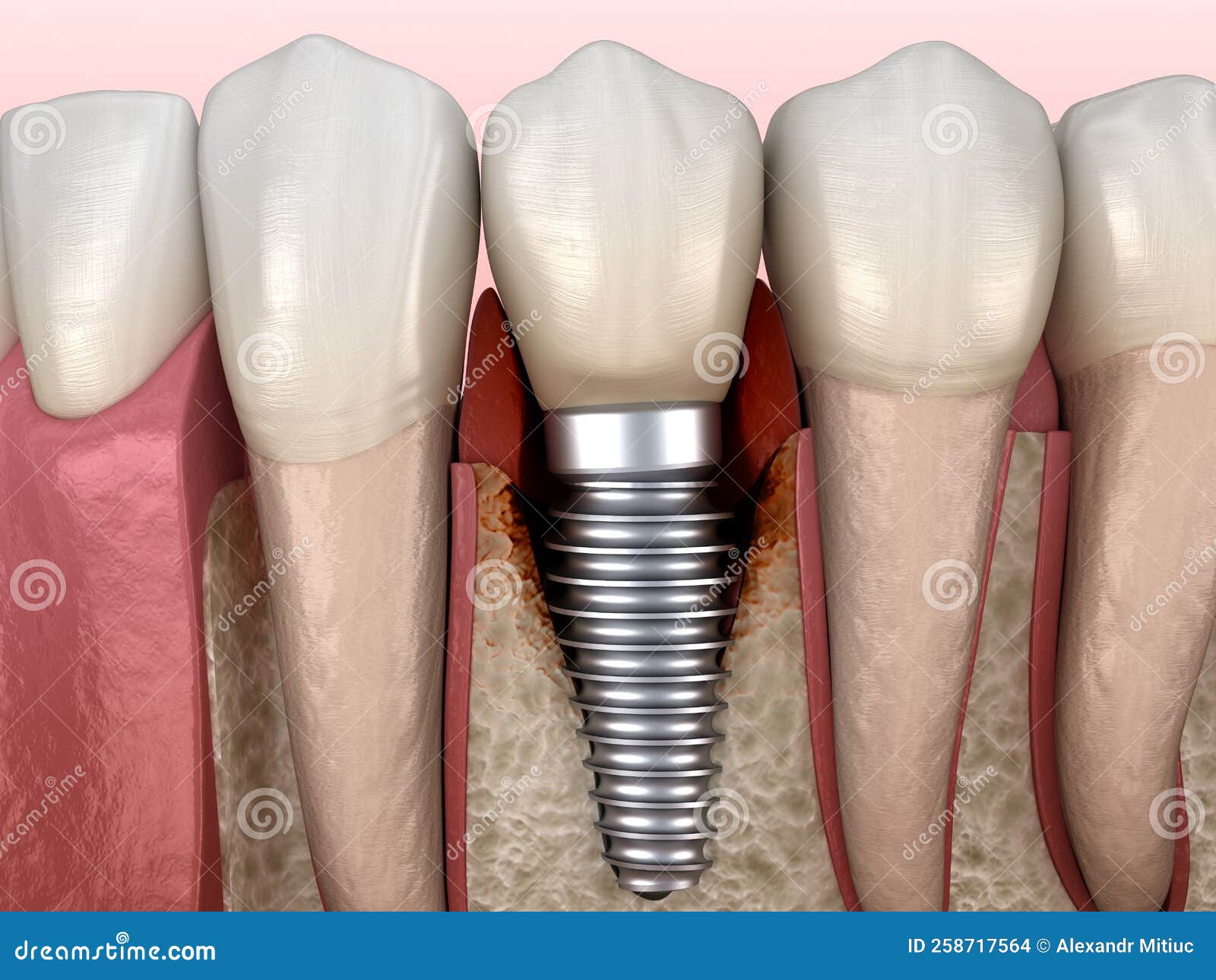 Periimplantitis with Visible Bone Damage. Medically Accurate 3D