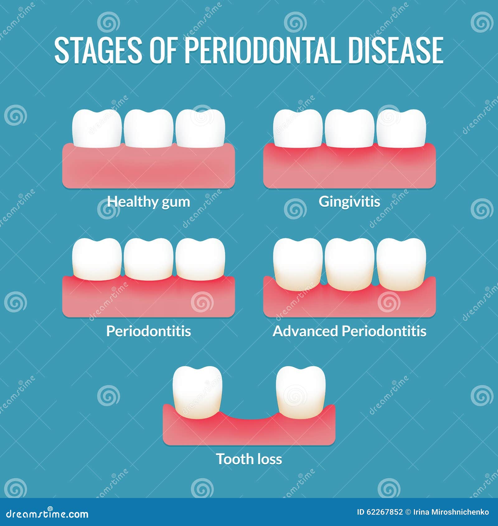 Perio Pocket Chart