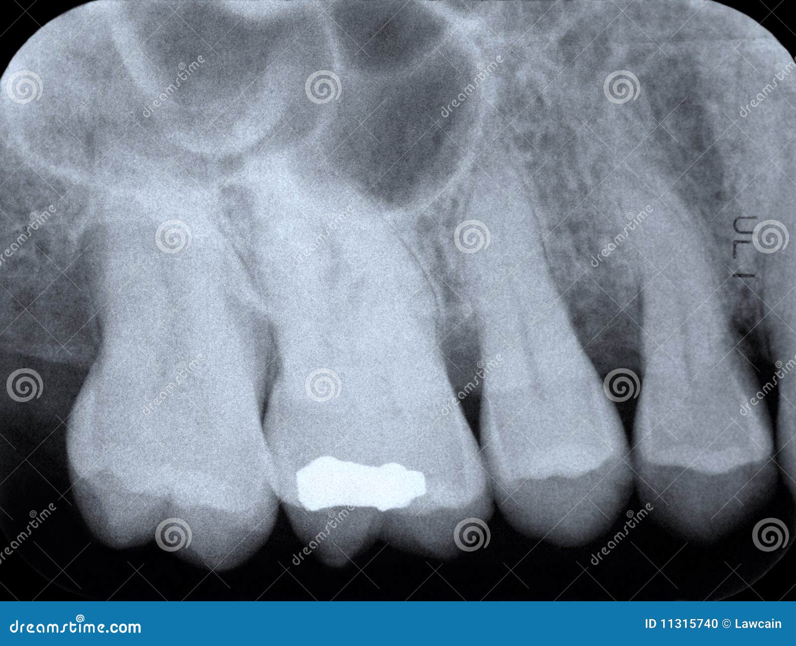 Periodontal Xray stock photo. Image of dental, gingival 11315740