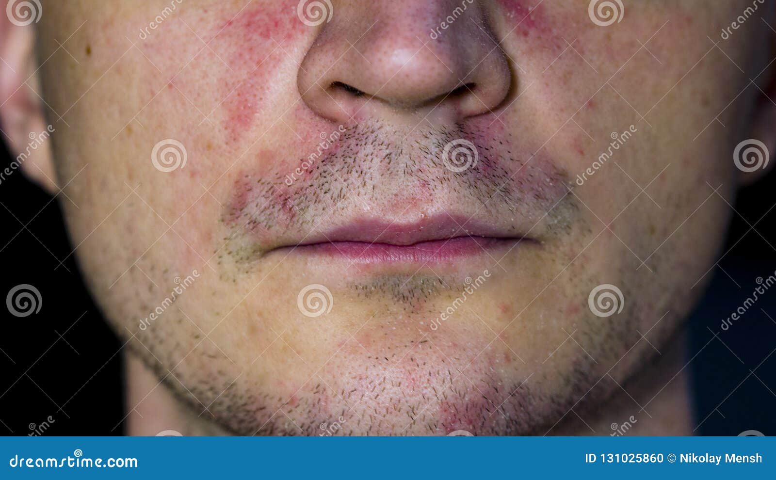 perioral dermatitis - skin disease on the face
