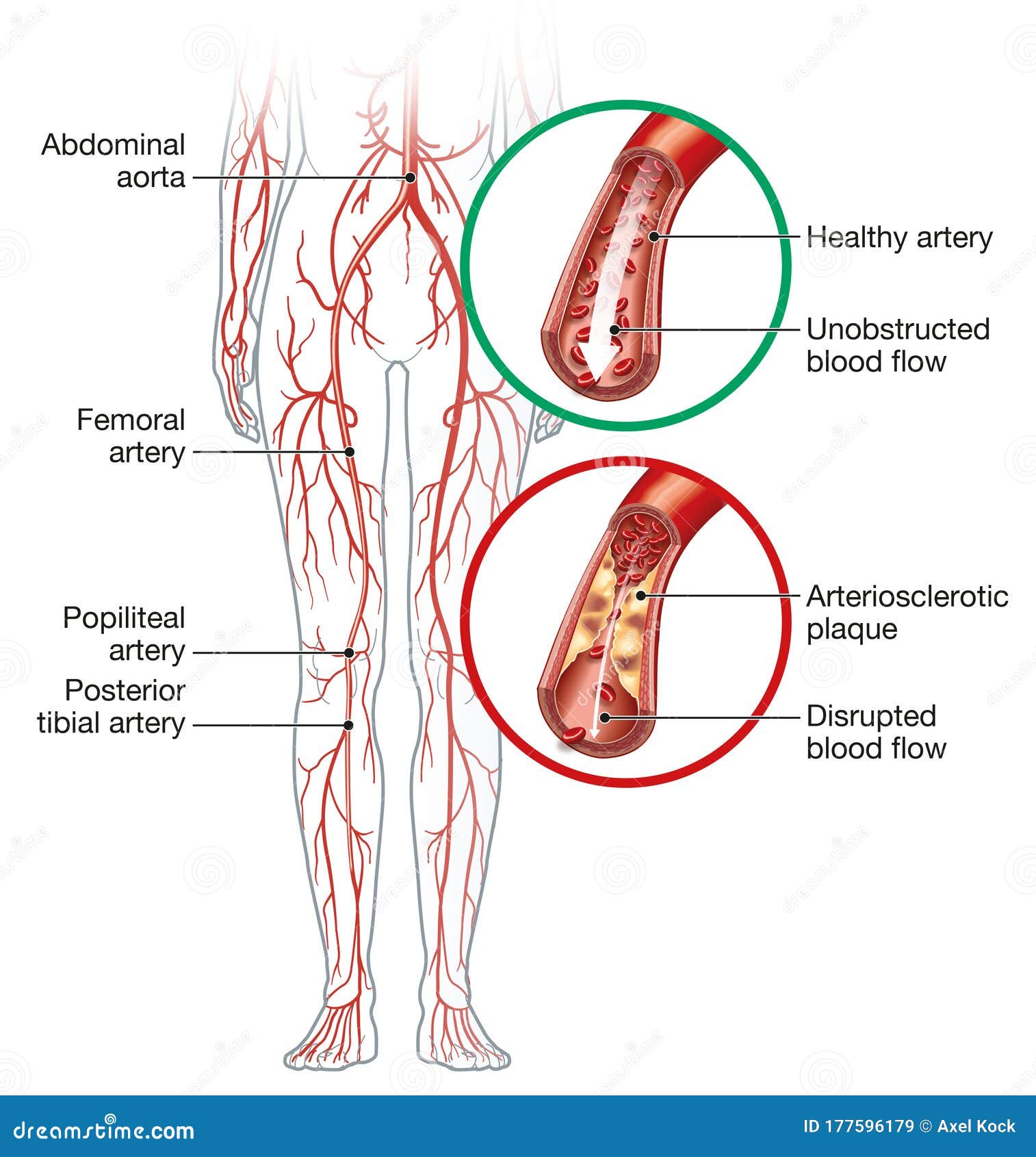 peripheral artery occlusive disease, intermittent claudication, medical 