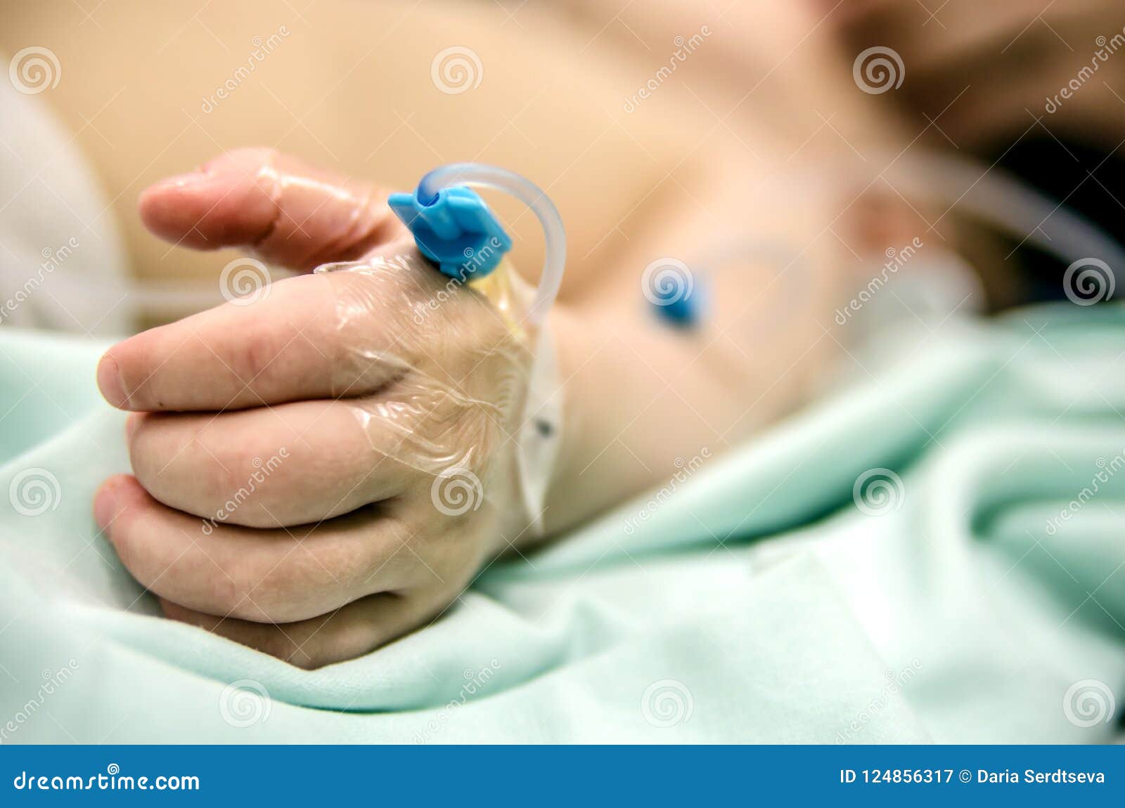 Peripheral Catheter on a Small Patient`s Hand before Operation. Stock
