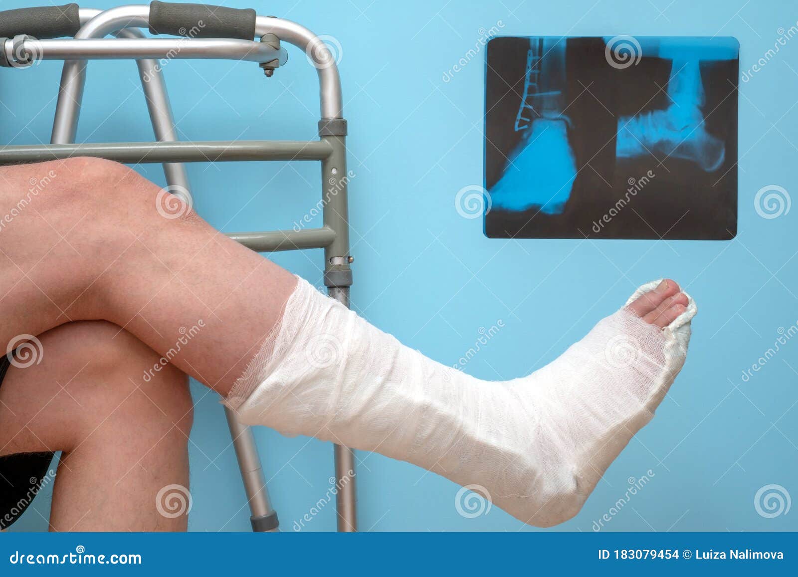 Quanto custa cirurgia perna quebrada?