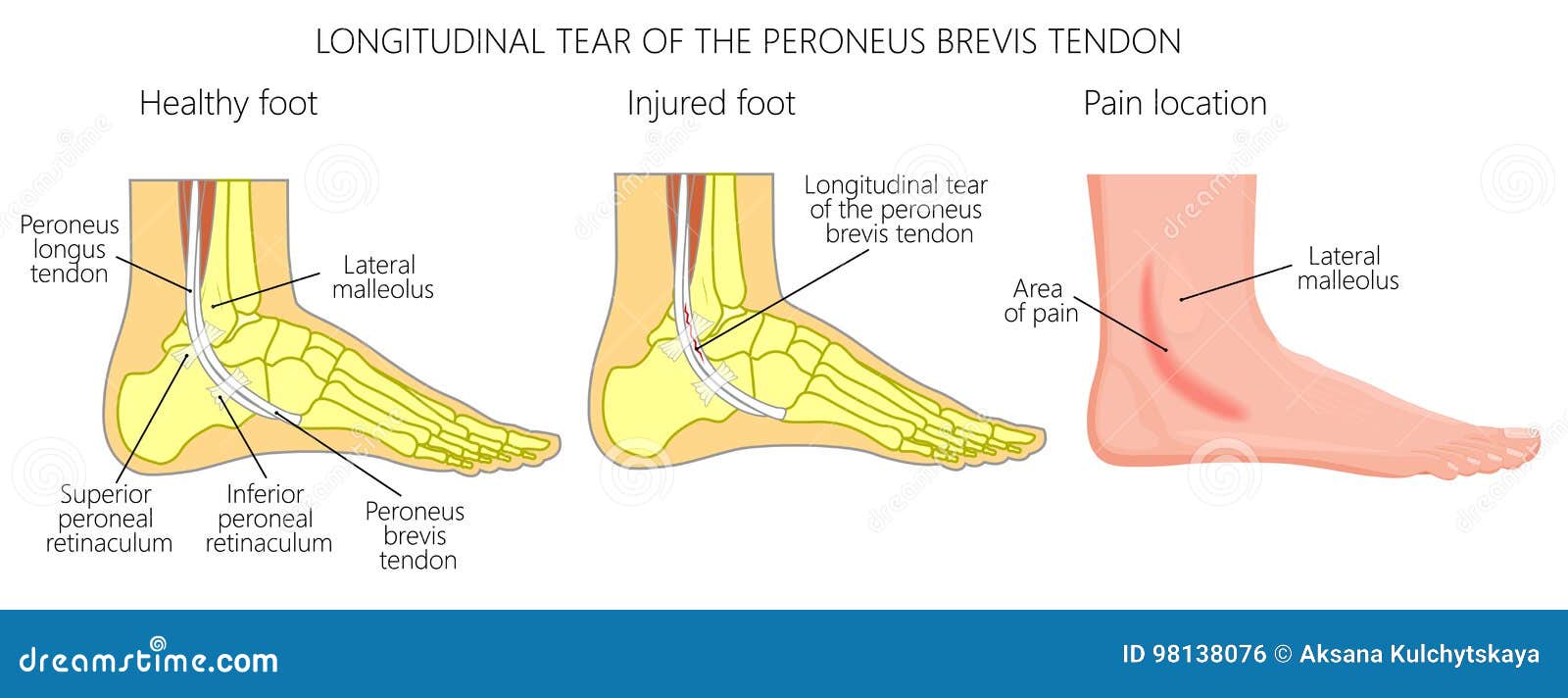 Peroneal Tendon Injuries_Longitudinal Tear of the Peroneus Brevis ...