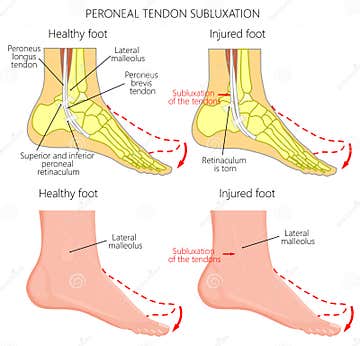 Peroneal Tendon Injuries_Peroneal Tendon Dislocation Stock Vector ...