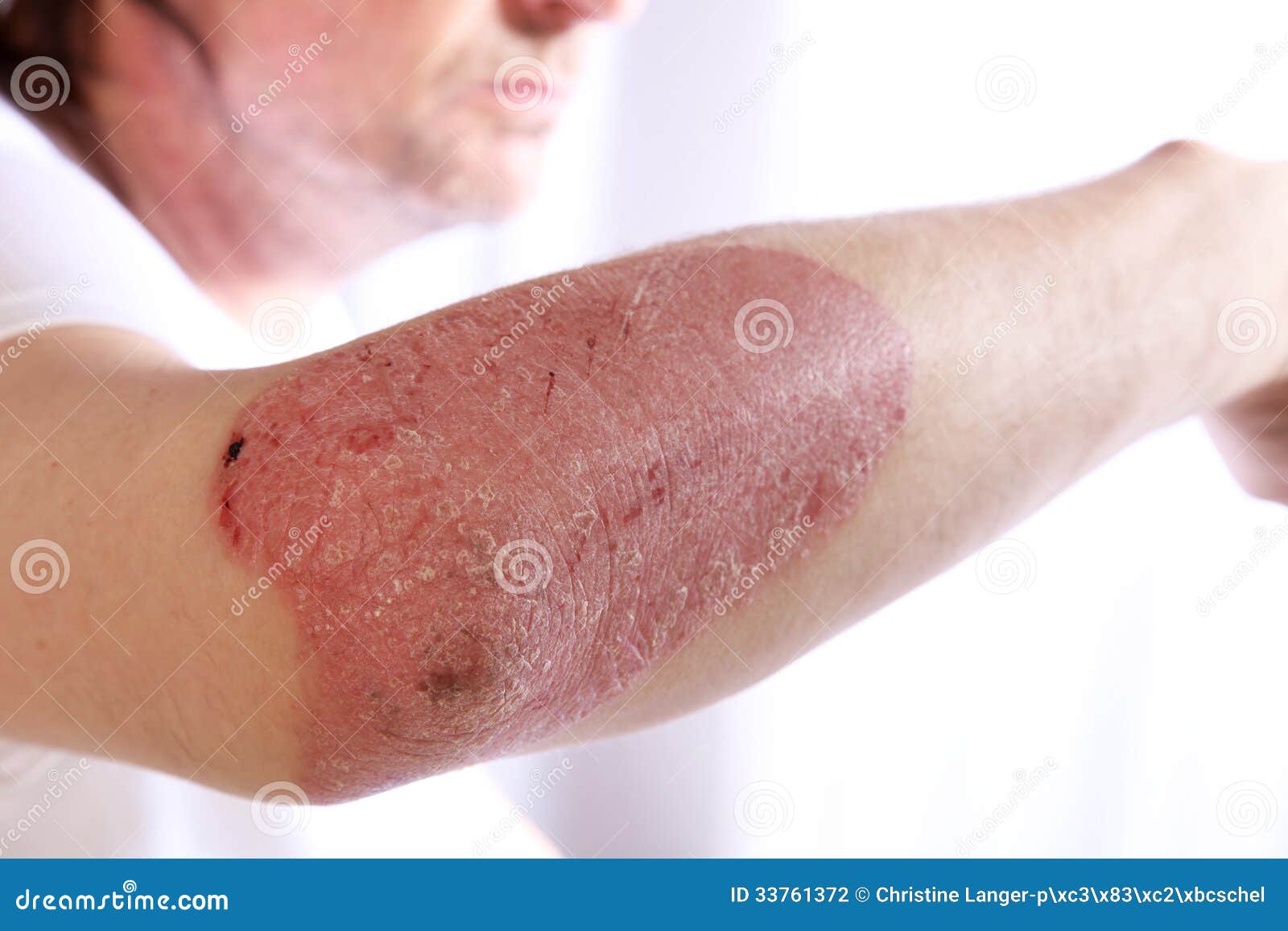 psoriasis painful elbows