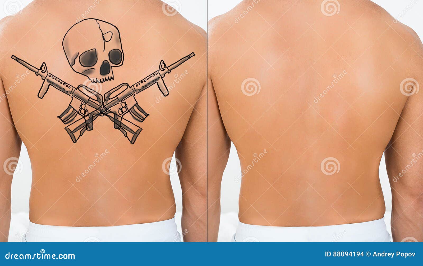 Person Showing Laser Tattoo Removal Treatment on Back Stock Photo - Image of indoors, death: 88094194 Person Showing Laser Tattoo Removal Treatment on Back Stock Photo - Image of indoors, death: 88094194