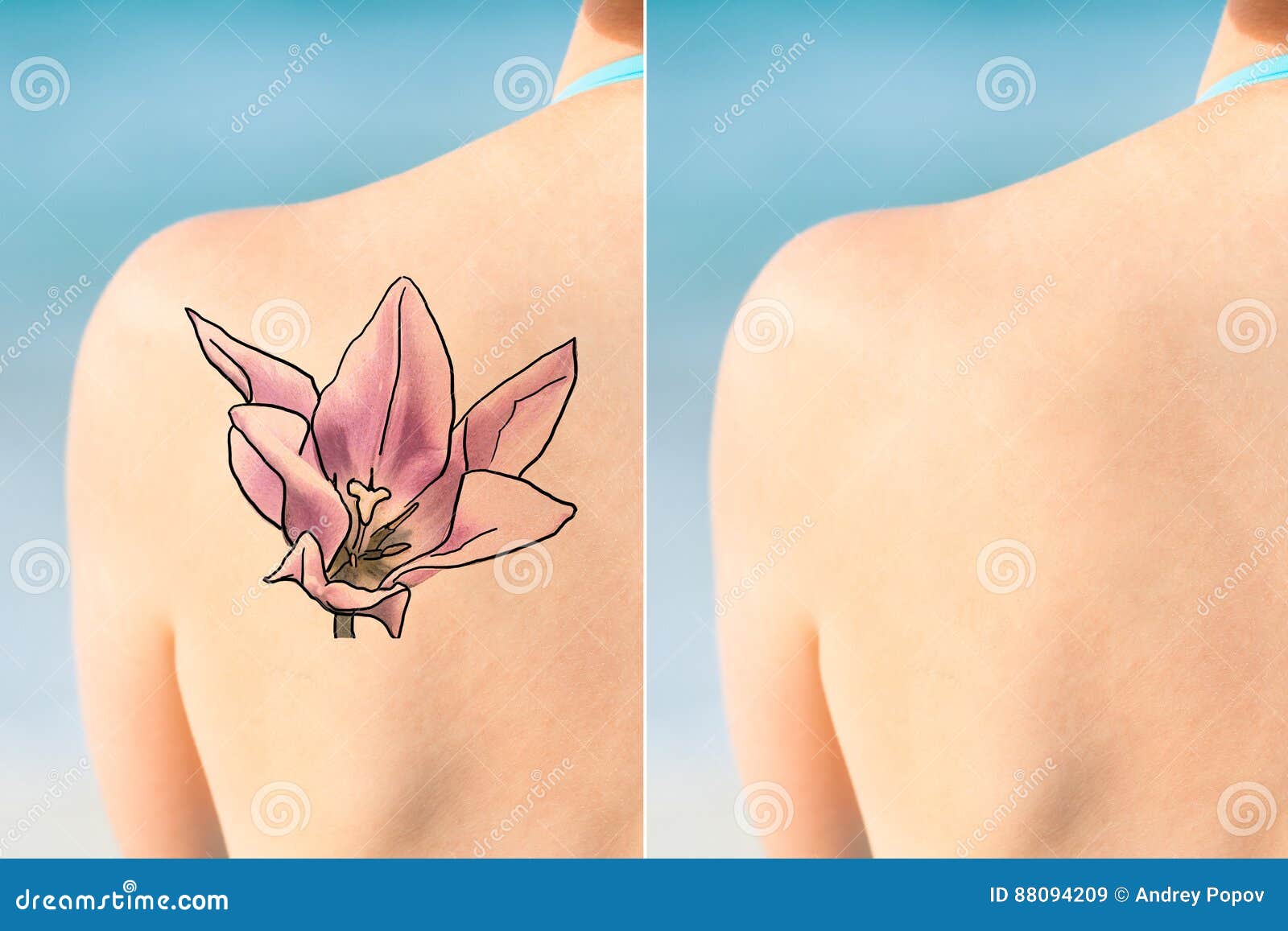 GO! Tattoo Removal