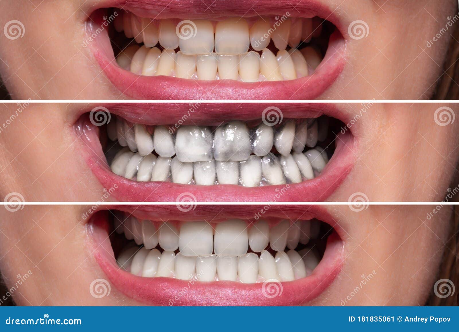 person teeth before and after cleaning