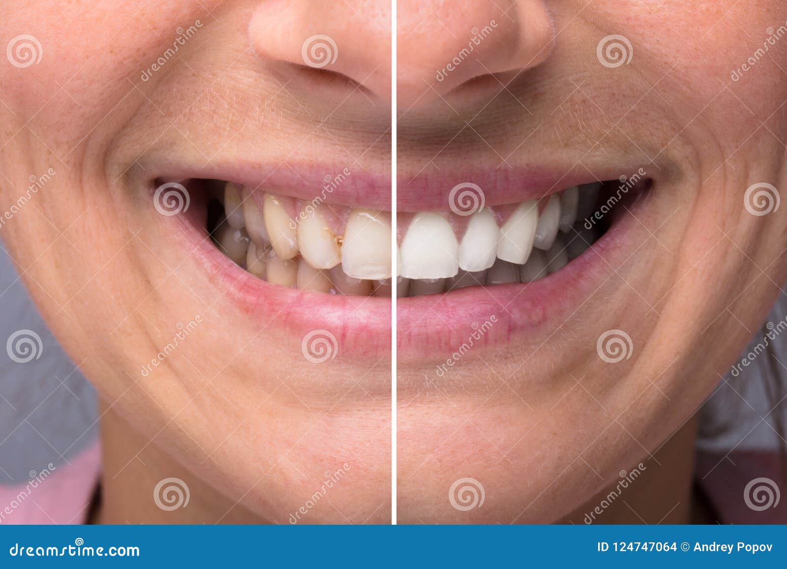 person teeth before and after whitening