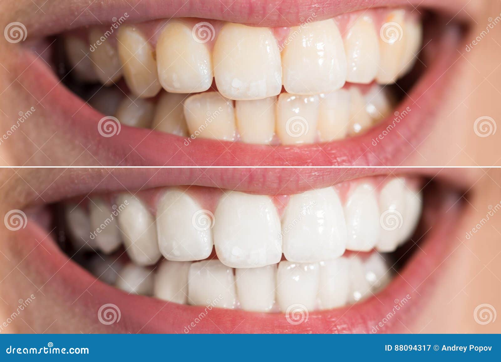 person teeth before and after whitening