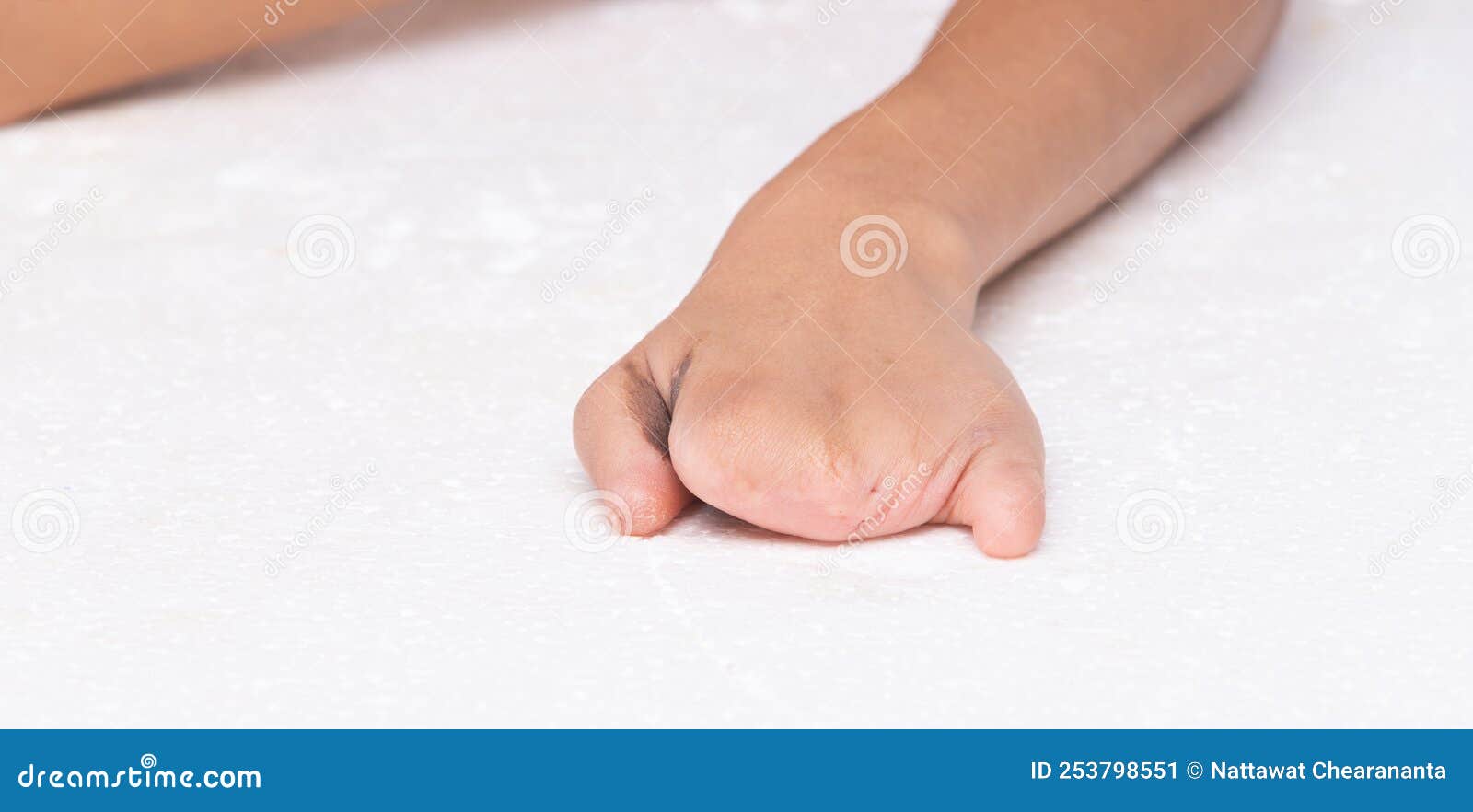 Persona Discapacitada Mano Sin Dedos Desde La Infancia Brilla Sin