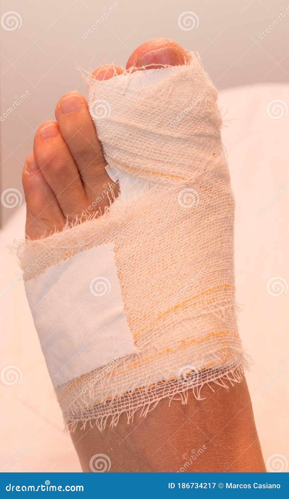 A Persons Bandaged Up Broken Big Toe Stock Image Image of injured