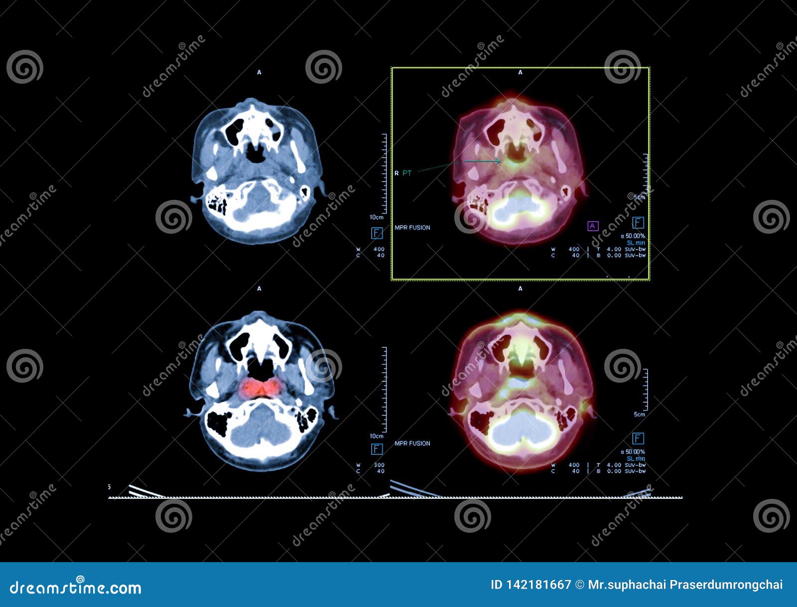 pet ct image of the brain showing ca nasopharynx.