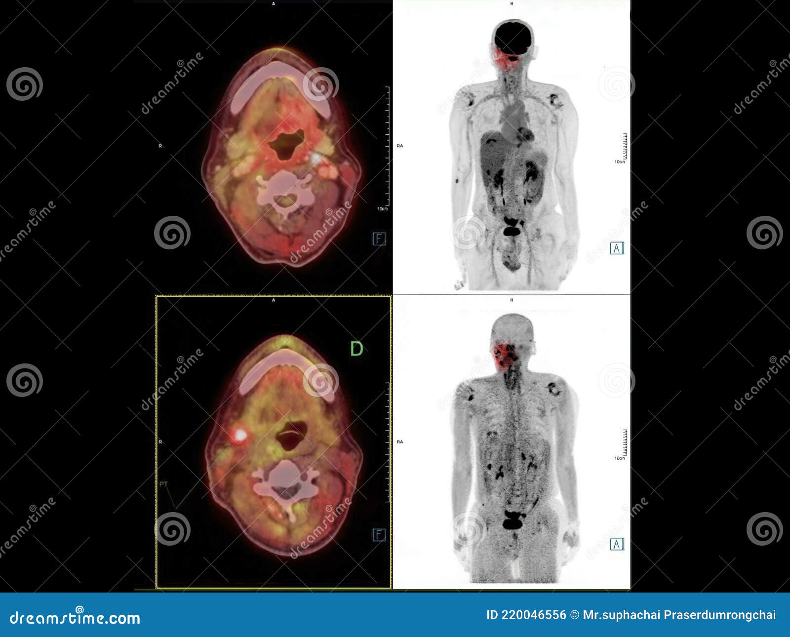 pet ct image of the neck showing ca nasopharynx or carcinoma of nasopharynx from pet ct scannner