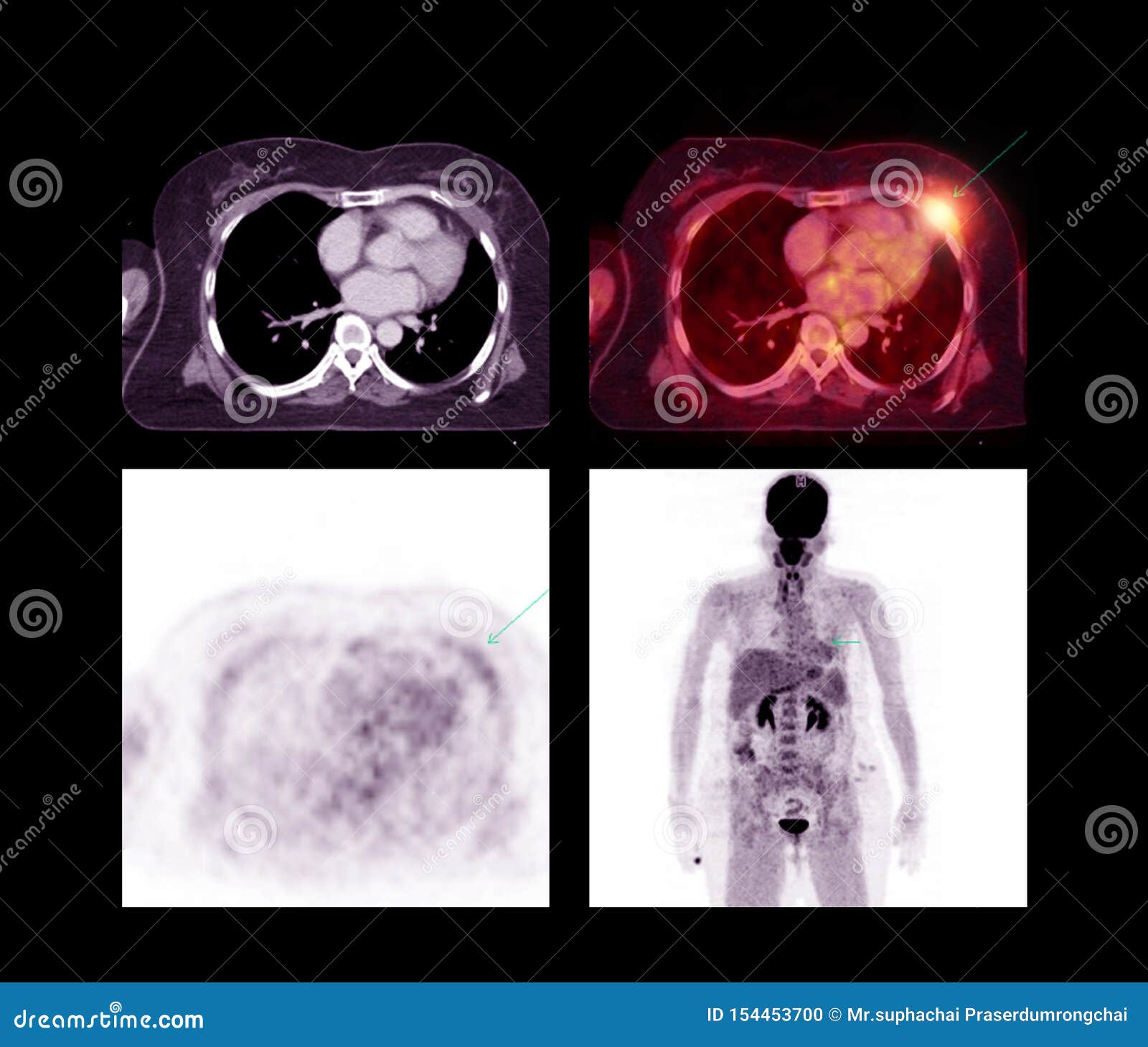 mesothelioma cancer pictures