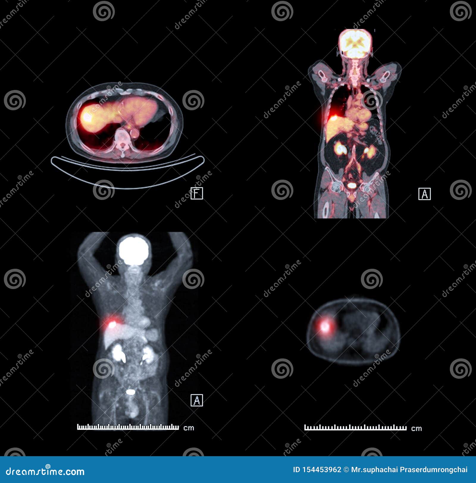 PET CT Scan Image of Body . Stock Photo - Image of axial, 154453962