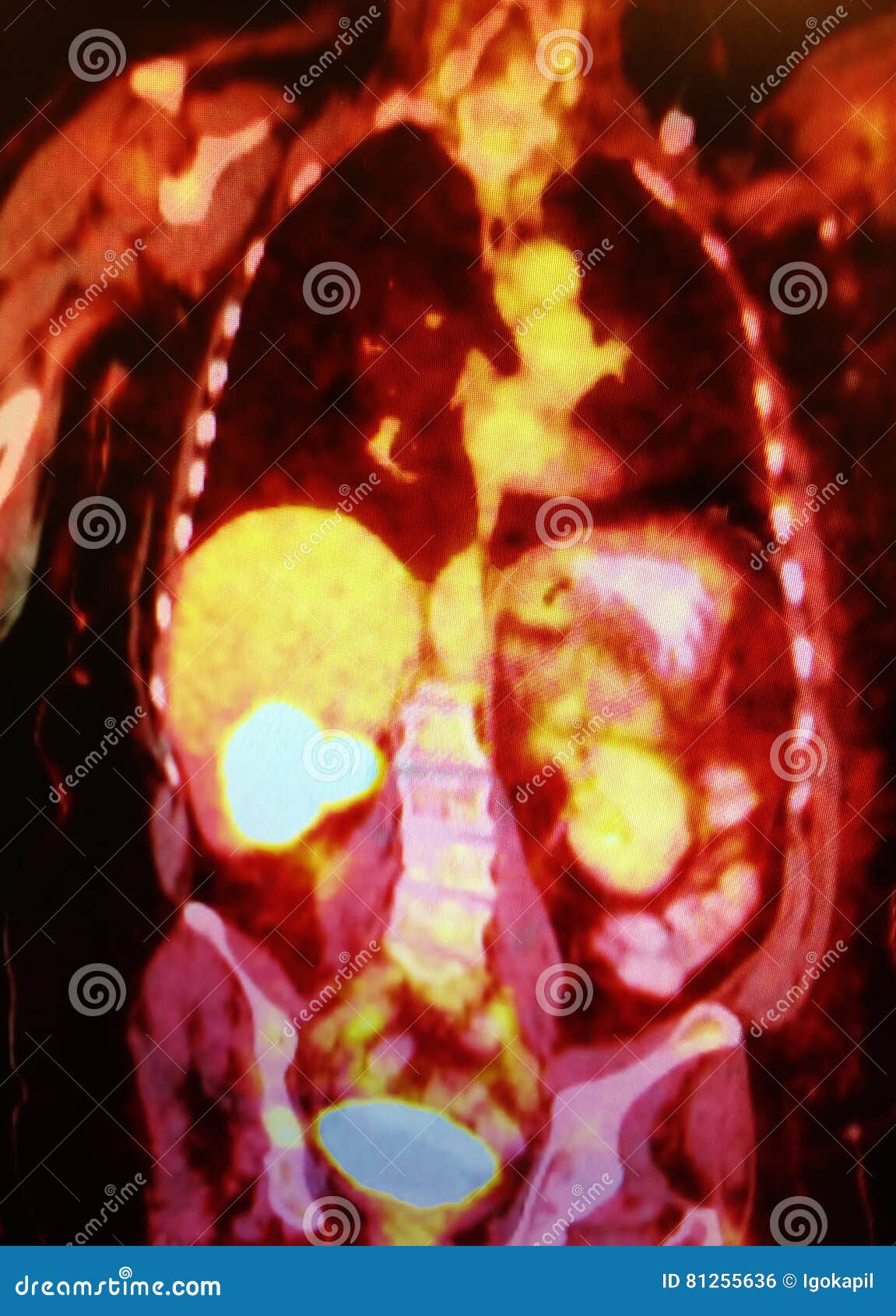 Pet scan images of liver cancer