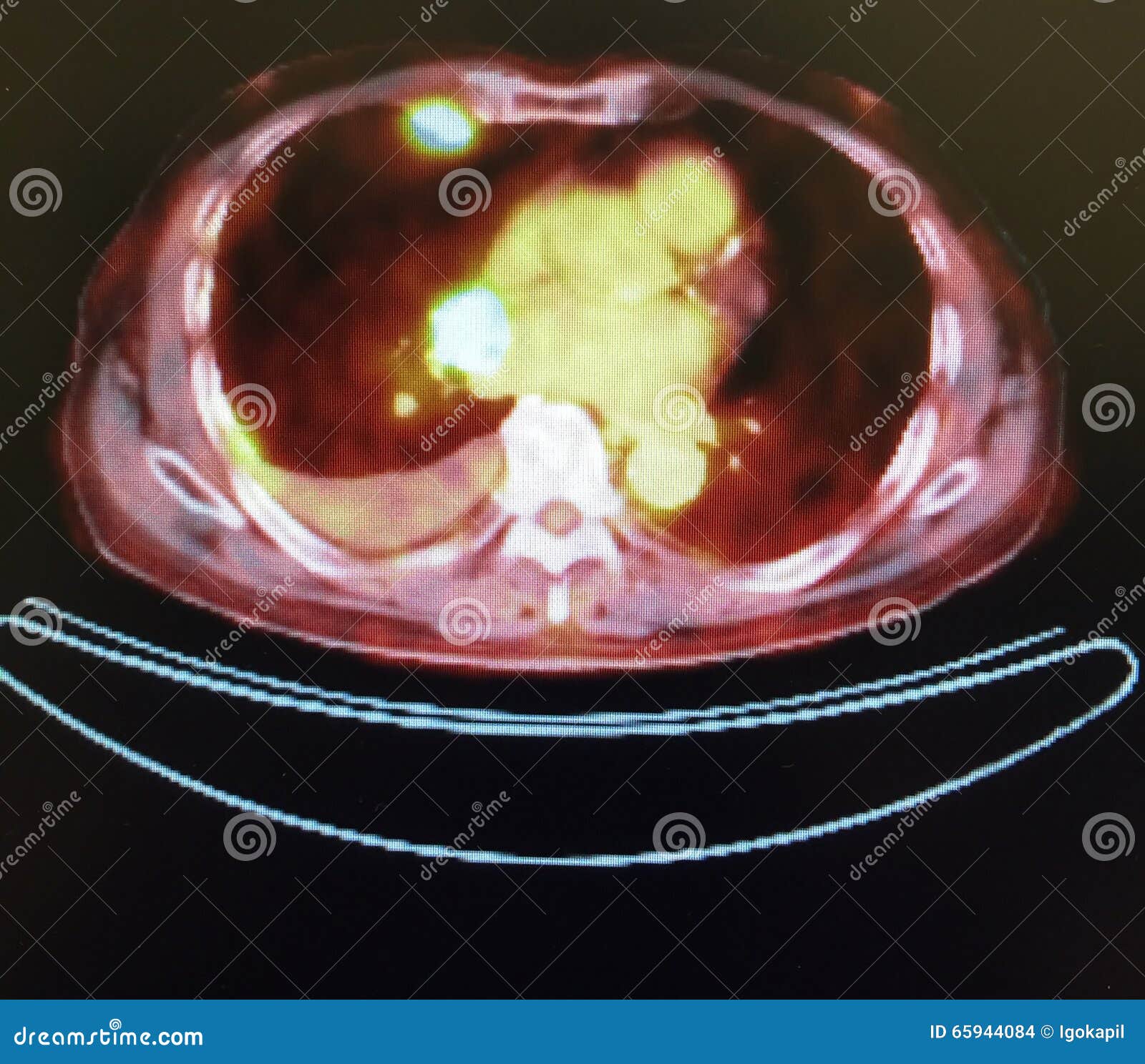 pet ct tumor mediastinum penetrating lung frame