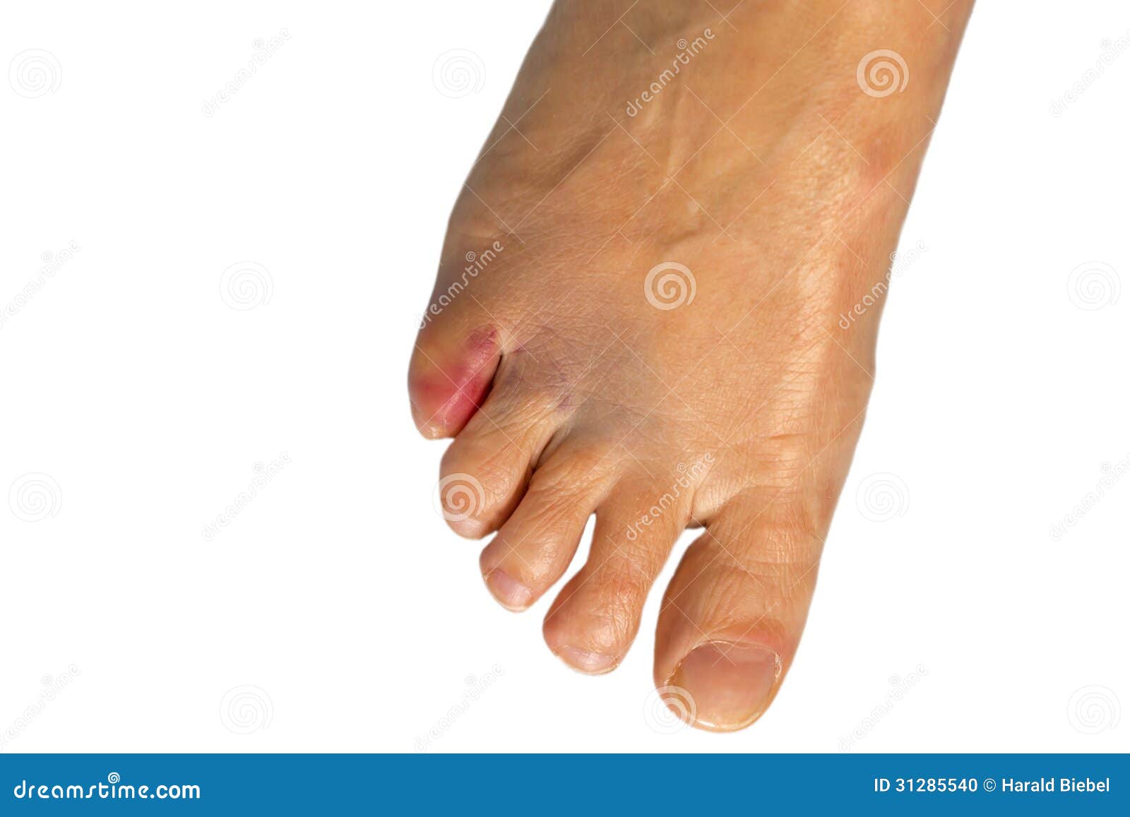 Petit Orteil Meurtri D