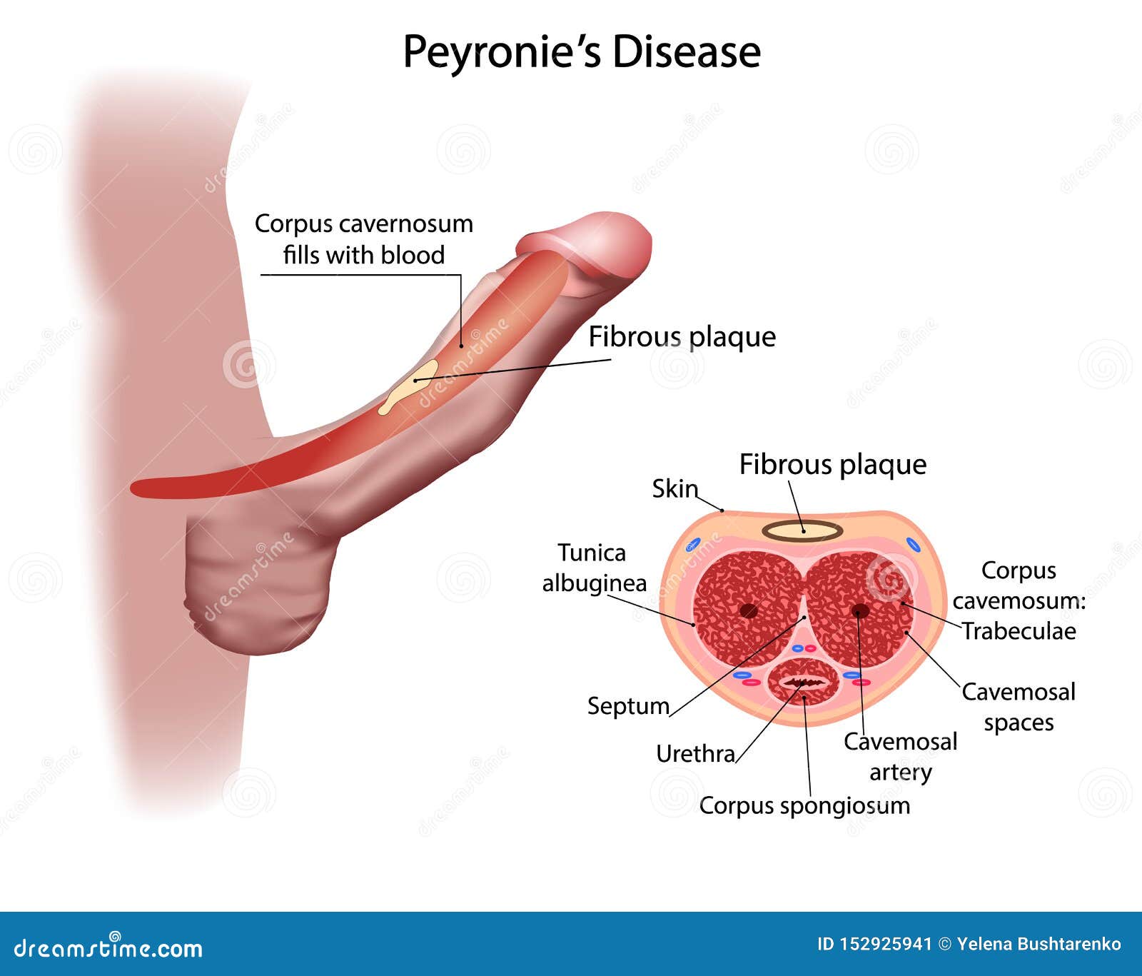 Peyronie`s disease, with formation of a fibrous plaque and deviation o...