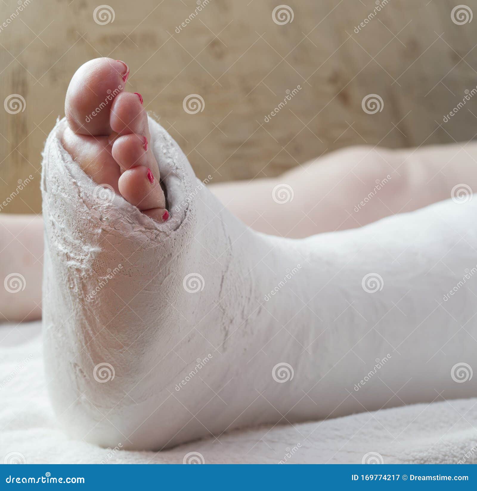 Photo about Simple photo of a women`s broken leg in a white cast. 