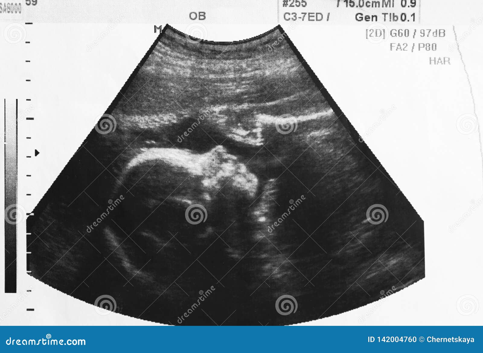 Photo D Ultrason De Bebe A Venir Dans L Uterus De La Mere Photo Stock Image Du Enfant Duree Photo D Ultrason De Bebe A Venir Dans L Uterus De La Mere Photo Stock Image Du Enfant Duree