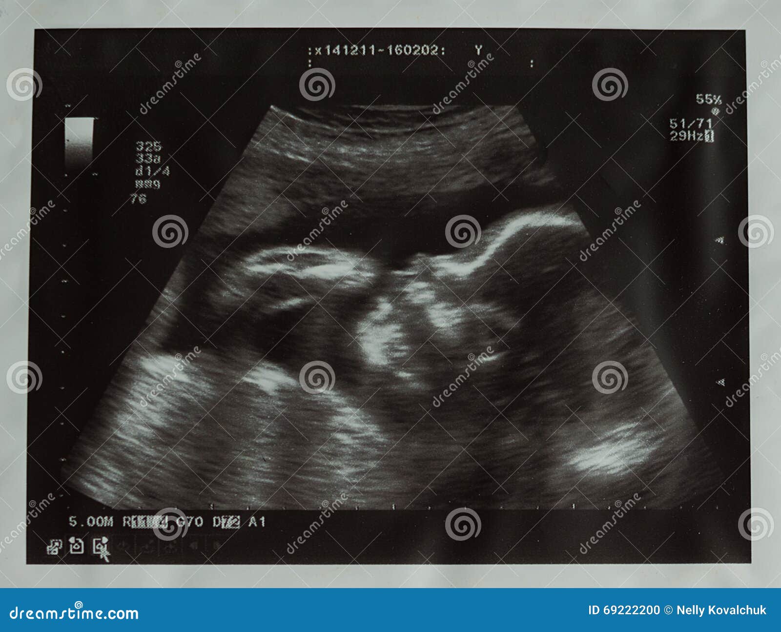 Photo D Ultrason De Bebe Photo Stock Image Du Fuselage