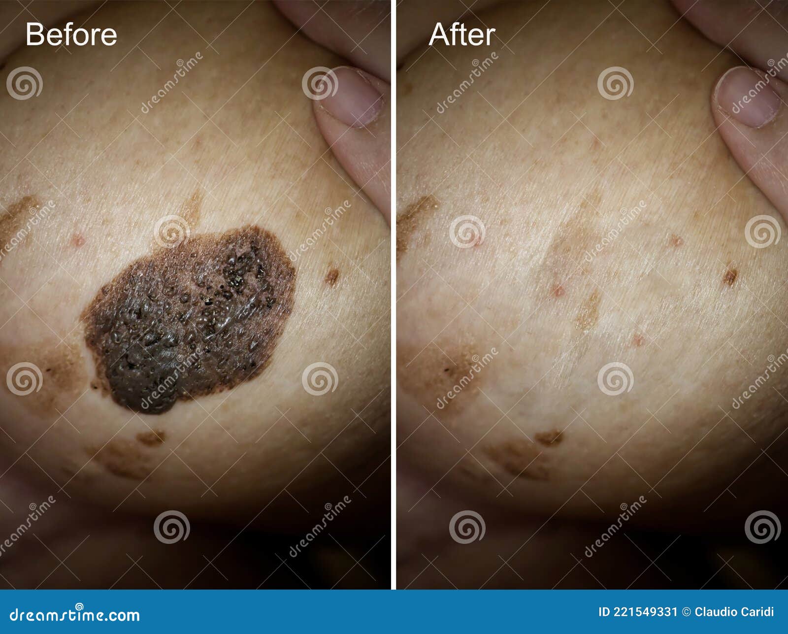 Photo Before And After Removal Of Large Mole On Woman`s Breast Mole