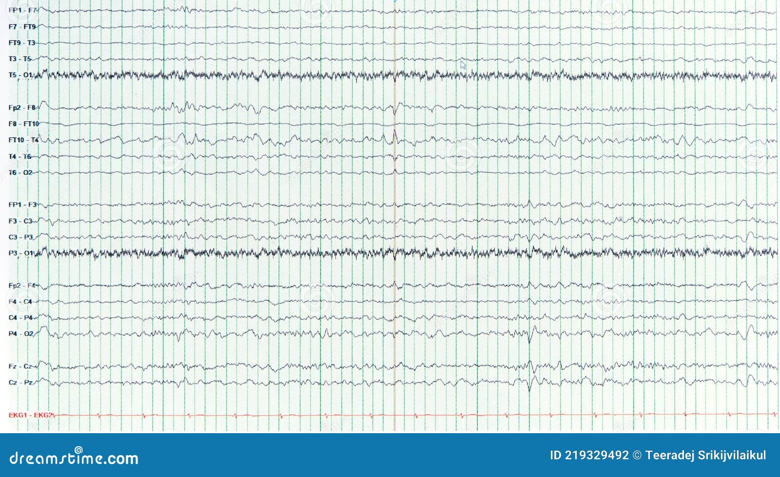 no eeg no eeg